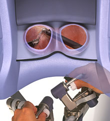 Illustration of what the surgeon sees using the da Vinci machine