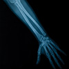 X-ray showing bones